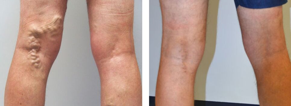 Φωτογραφία πριν και μετά τη χρήση του Veniselle, η εμπειρία της χρήσης κρέμας