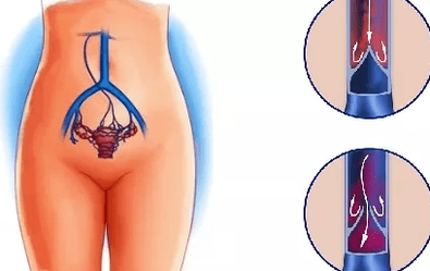 Οι λόγοι για την ανάπτυξη κινεζικών φλεβών της λεκάνης