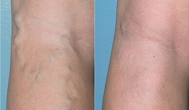 Πώς να θεραπεύστε τις κιρσοί των φλεβών στα πόδια