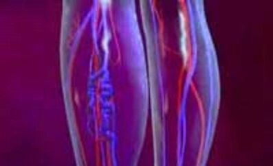 Αιτίες και θεραπεία των κινεζικών φλεβών