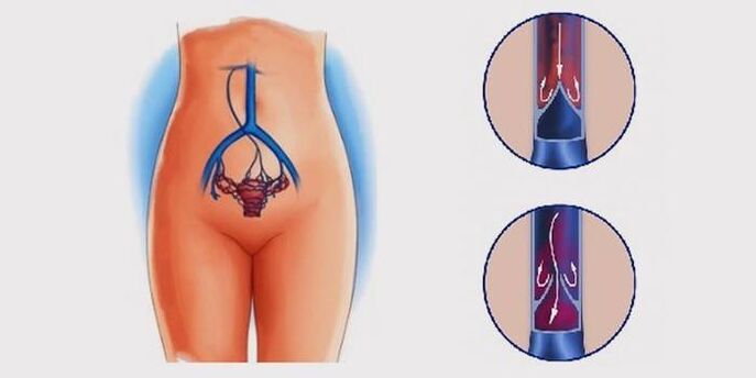 Κιρσοί της λεκάνης