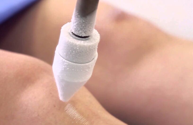 Αντιμετώπιση κιρσών στα πόδια με κρυοθεραπεία