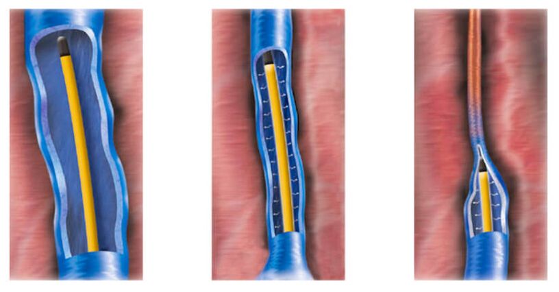 Η κατάλυση με ραδιοσυχνότητες ως μέθοδος αντιμετώπισης των κιρσών