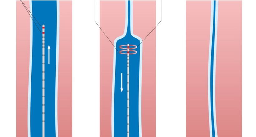 Θεραπεία με λέιζερ κιρσών στα πόδια